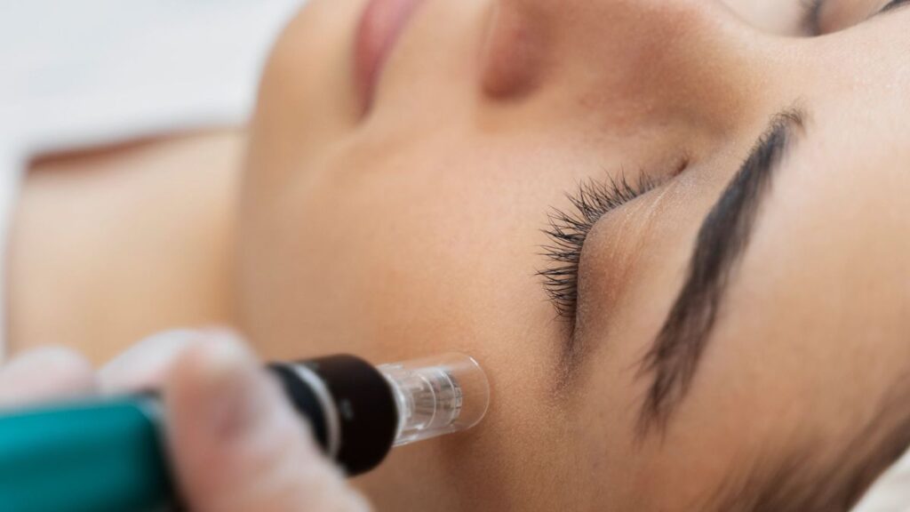 Skin Needling