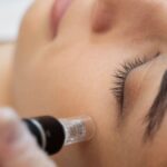 Skin Needling